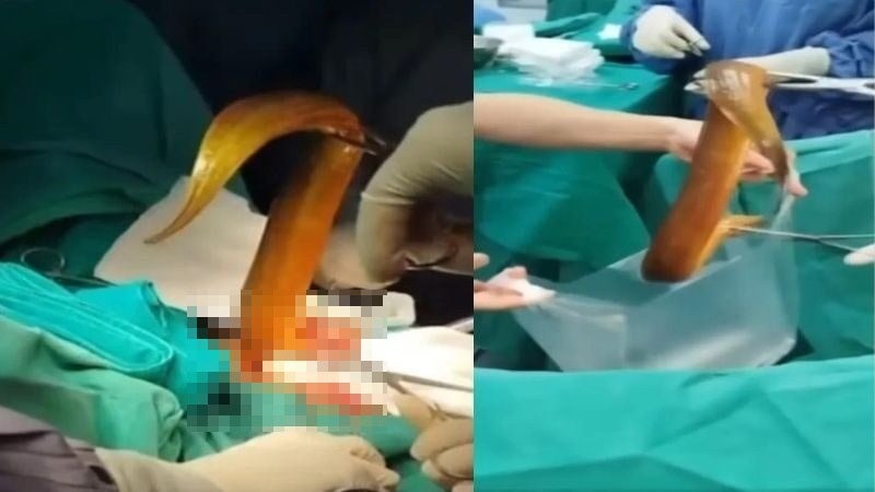 - Una anguila viva de 60 centímetros mastica los intestinos de un hombre