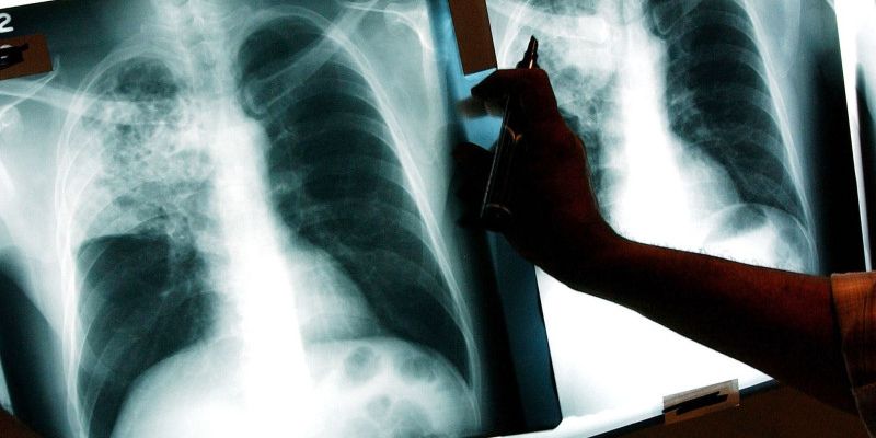 La tuberculosis vuelve a ser la enfermedad infecciosa más mortal