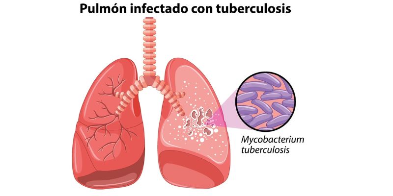 La tuberculosis vuelve a ser la enfermedad infecciosa más mortal