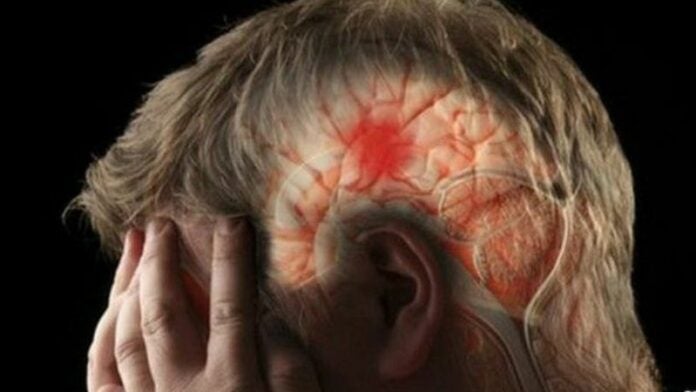 Factores de riesgo relacionados con sufrir un derrame cerebral severo