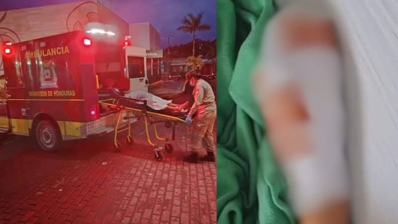 Niño que perdió la mano por mortero en Roatán necesitará prótesis