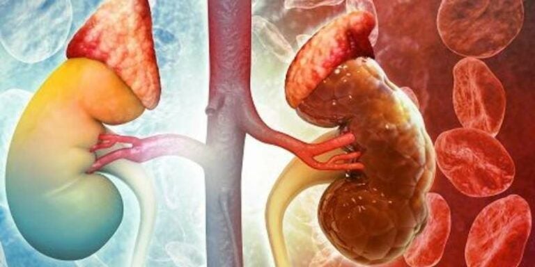 ¡Alerta! La enfermedad renal crónica que podría superar en muertes al cáncer