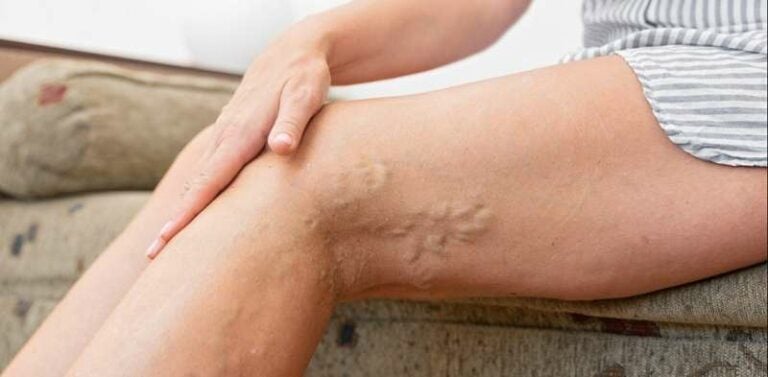 Cuide sus piernas: 10 consejos para controlar las varices