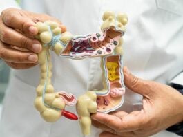 Diverticulitis: síntomas, tratamiento y prevención de esta afección digestiva