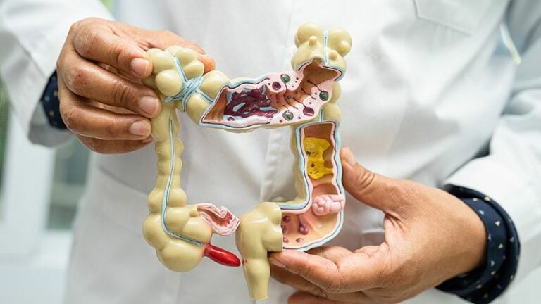 Diverticulitis: síntomas, tratamiento y prevención de esta afección digestiva