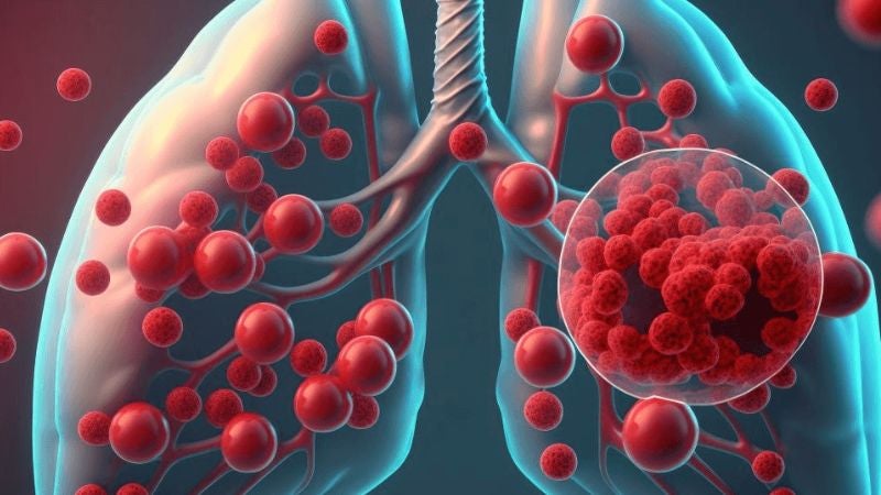 Hoy es el Día Mundial de la Sarcoidosis, una enfermedad inflamatoria crónica y poco común