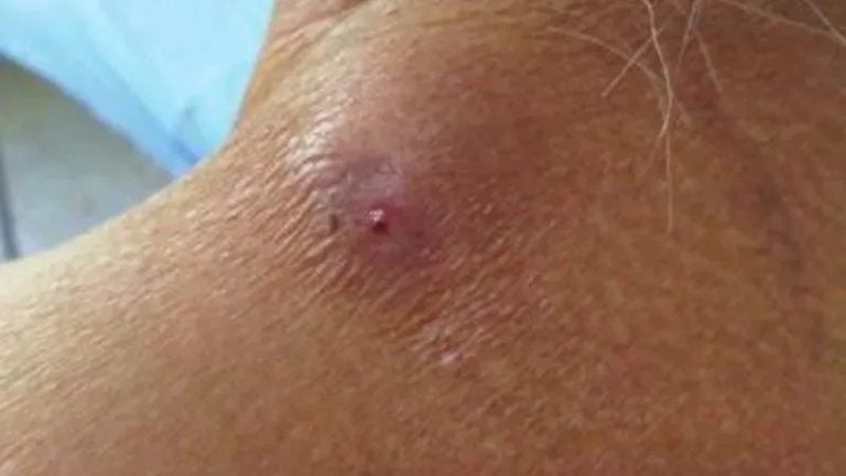 ¿Cómo evitar las infecciones por gusano barrenador en humanos?