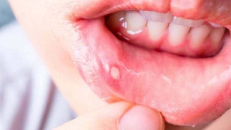Llagas en la boca de los niños: causas y formas de prevenirlas
