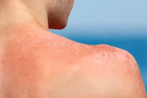 Semana Santa: Razones broncearte sin protección