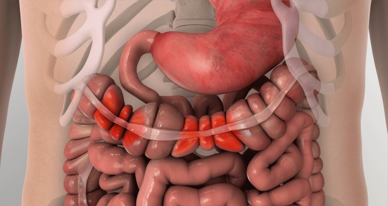 ¿Por qué las mujeres son más propensas al síndrome del intestino irritable?