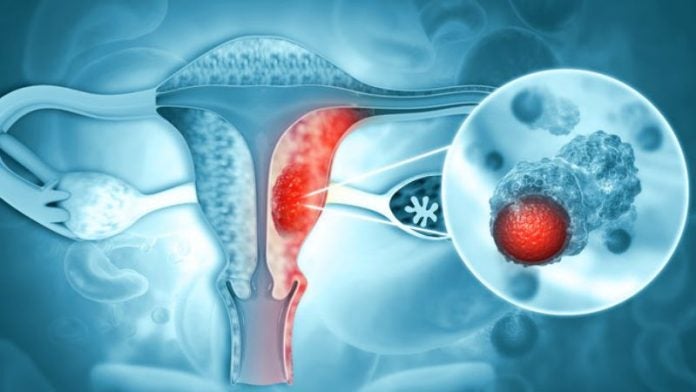 Cáncer de ovario: señales silenciosas que debes conocer