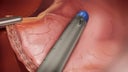 create-gastric-pouch