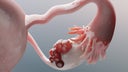 ovarian-malignant-tumor-female-uterus-anatomy-reproductive-system-cancer-cells-ovaries-cysts-cervical-cancer-growing-cells-gynecological-disease-metastasis-cancerous-duplicating-3d-render