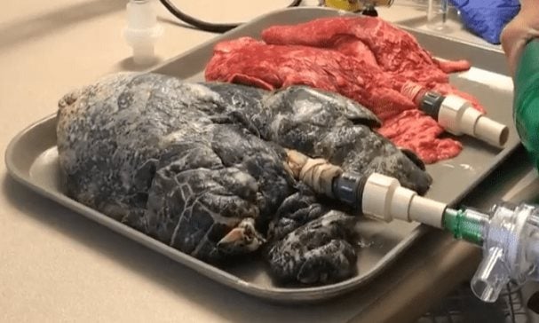 Cáncer de pulmón