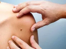 El cáncer de piel aumenta en jóvenes: especialistas alertan