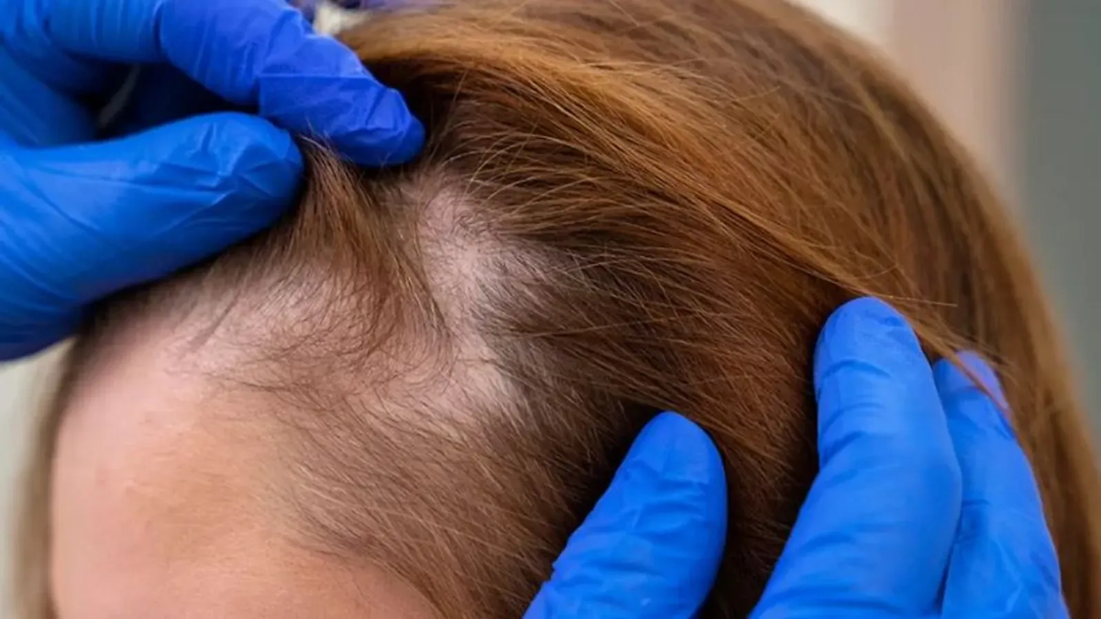 caída del cabello en la menopausia