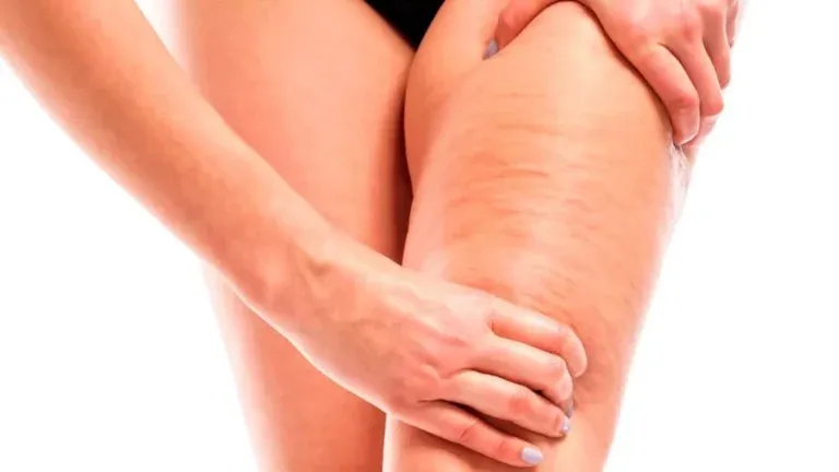 tratamientos contra la celulitis