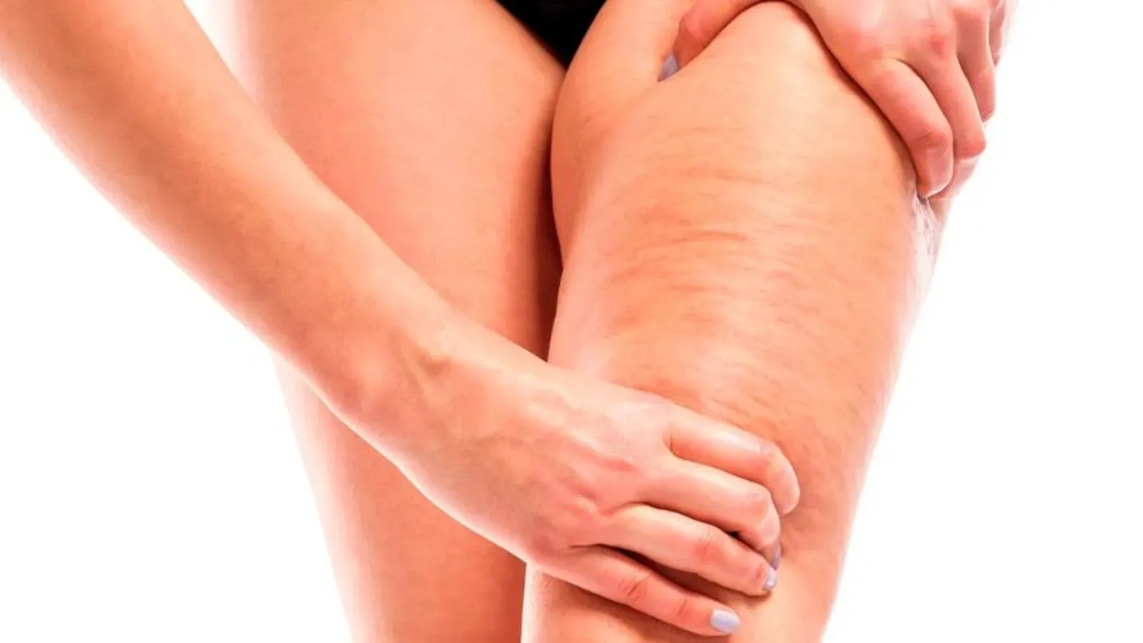 tratamientos contra la celulitis