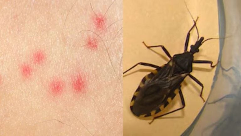 mal de Chagas
