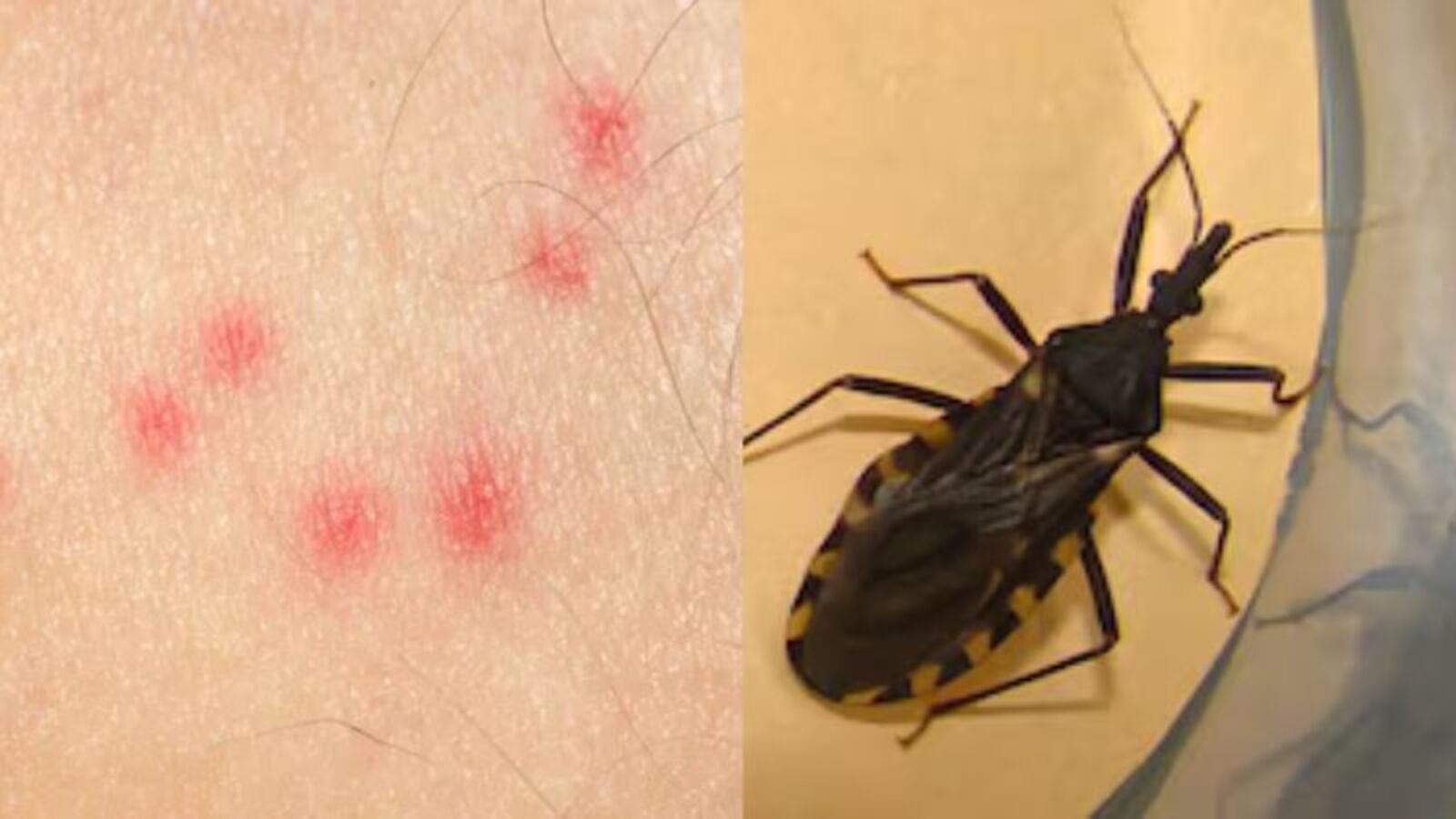 mal de Chagas