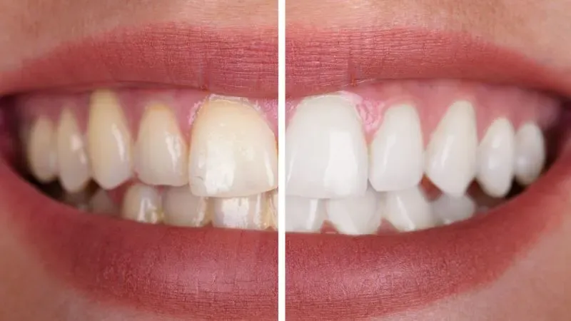 Hábitos cotidianos que manchan los dientes y dañan el esmalte