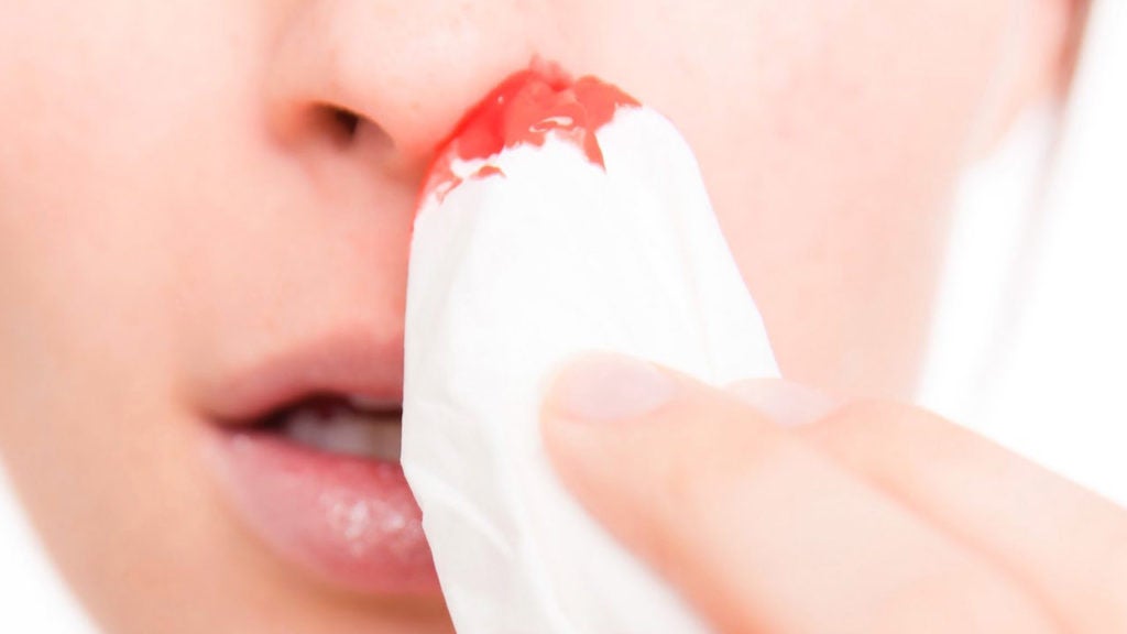 sangrado nasal